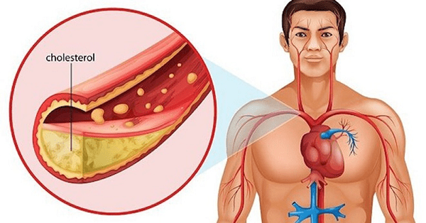 Kiểm soát huyết áp và lượng cholesterol trong máu