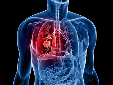 Hoa Kỳ phê duyệt thuốc mới điều trị ung thư phổi di căn