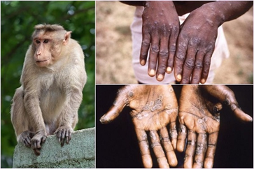 Virus đậu mùa khỉ đã đột biến nhanh gấp 12 lần thông thường
